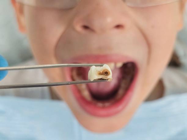 Best Emergency Dental Care for Abscessed Tooth in Capac, MI